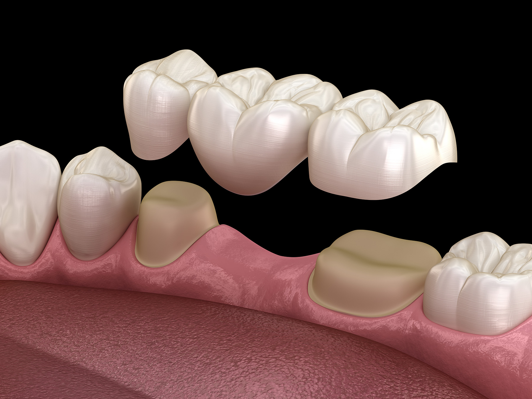 Zen Dentistry | Gum Therapy, Night Guards and Inlays & Onlays