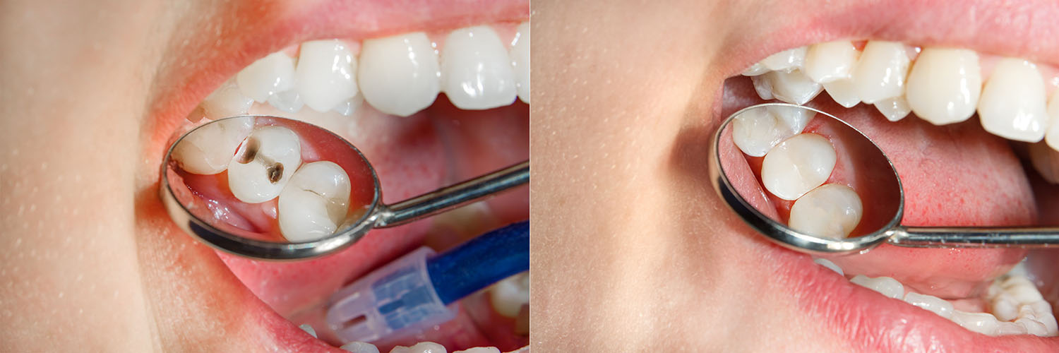 Zen Dentistry | Dental Bridges, Dental Fillings and Implant Dentistry