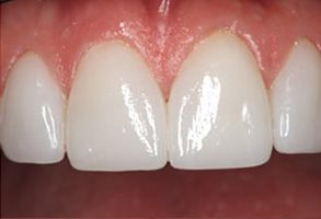 Zen Dentistry | Dental Cleanings, Gum Therapy and Teeth Whitening