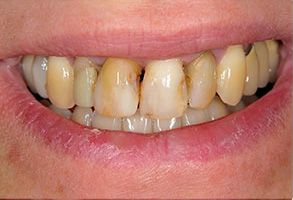 Zen Dentistry | Veneers, Crowns and Teeth Whitening