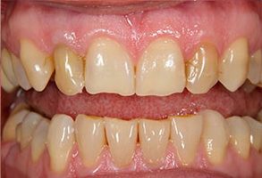 Zen Dentistry | Crowns, Veneers and Dental Fillings